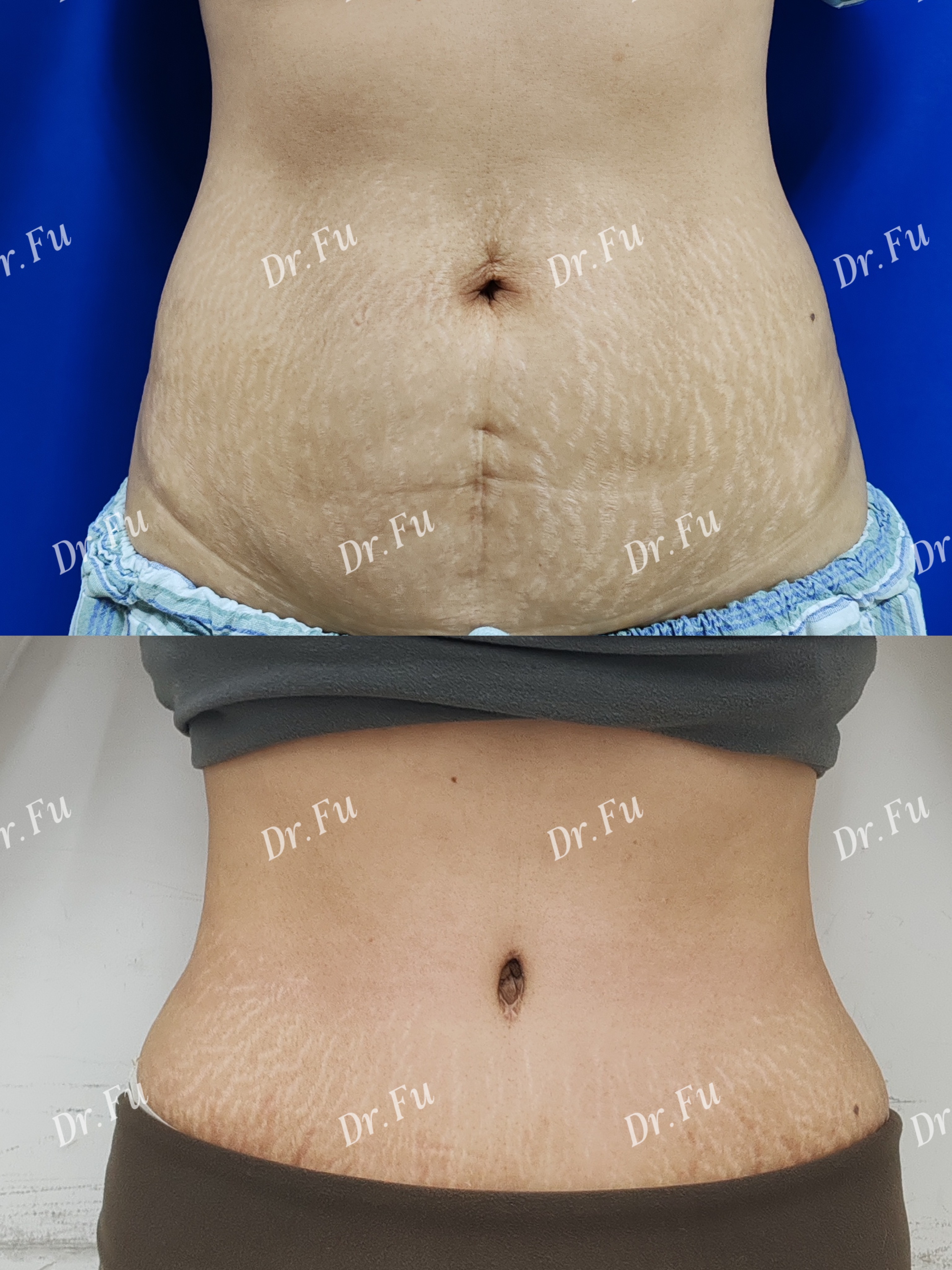 Abdominoplasty Case 8